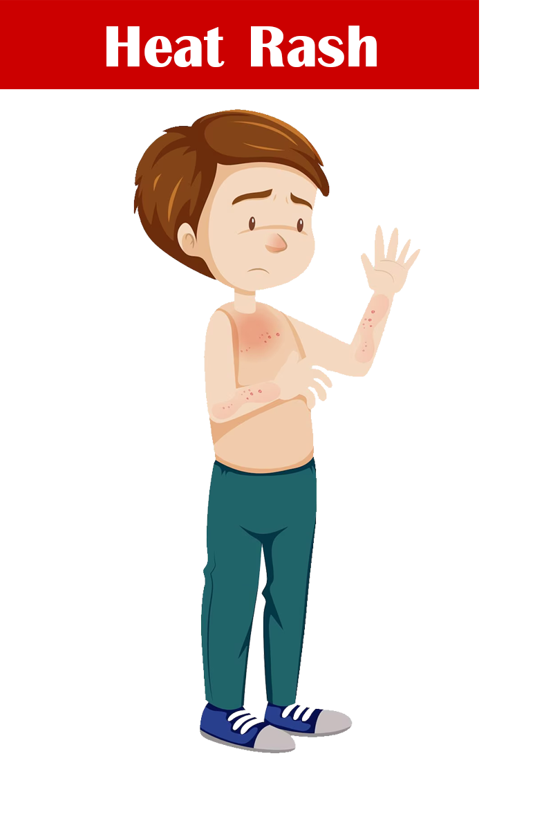 ผิวหนังอักเสบ และผดร้อน (Heat Rash)